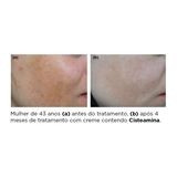 Clareador de Melasma Cisteamina