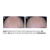 Clareador de Melasma Cisteamina